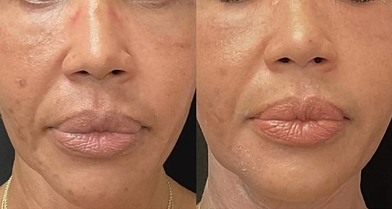 Before and after skincare treatment comparison.